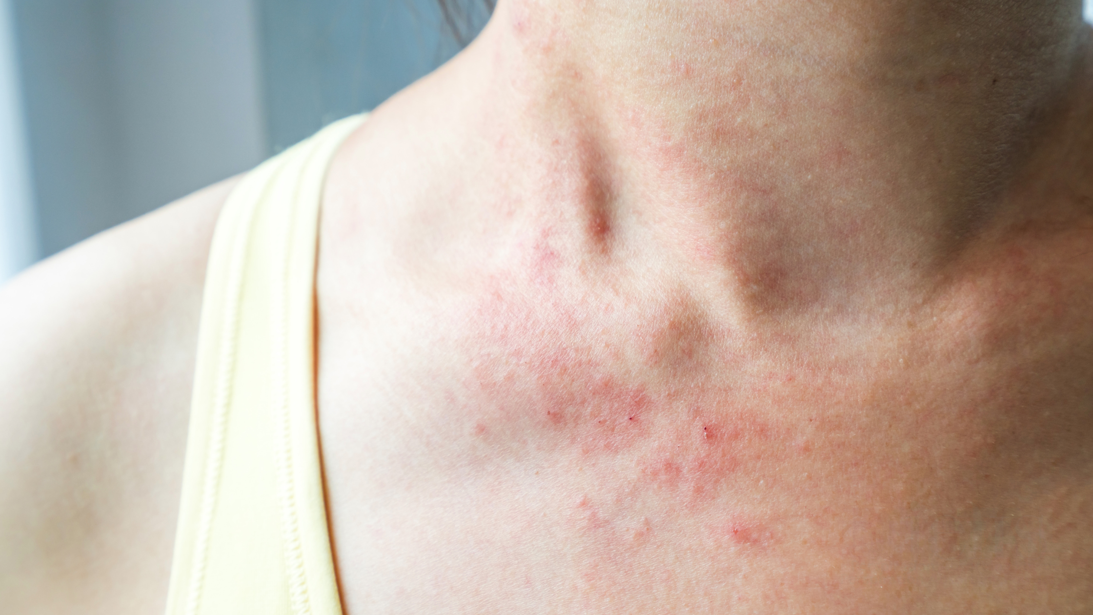 Sweat Rash Arms Beat the Heat: Managing Sweat Rash – DRITAL